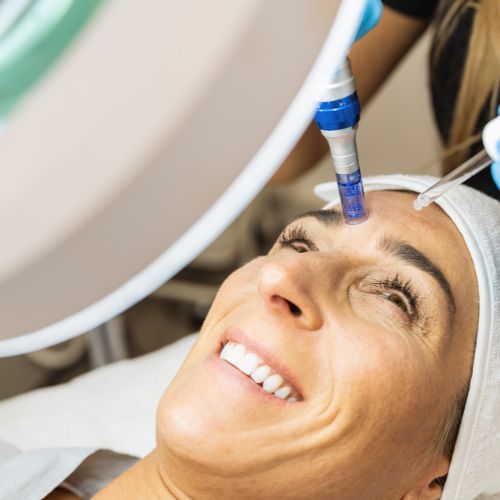 tratamiento con microneedling en Zaragoza